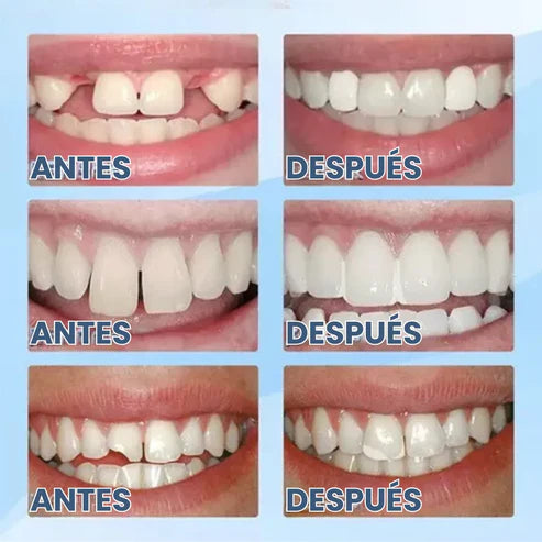 Moldeador para dentadura | Fácil de Usar en Casa